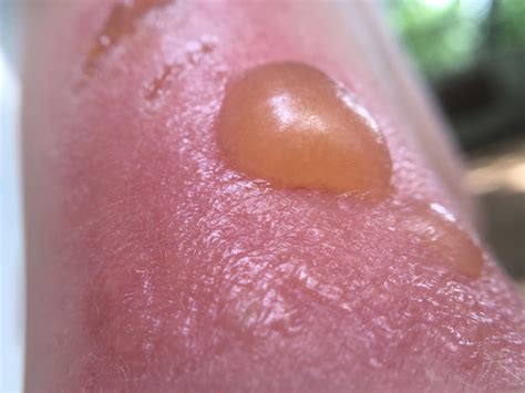 why is my sunburn leaking yellow|Sun Blisters: How to Treat Them and How Long They Last